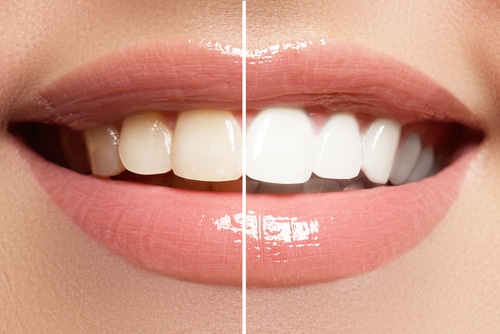 teeth whitening meridian id
